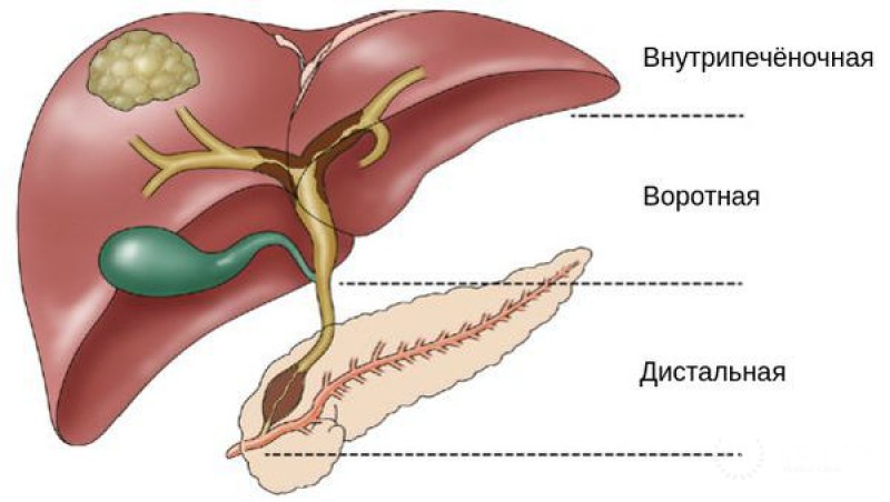 Холангиокарценома