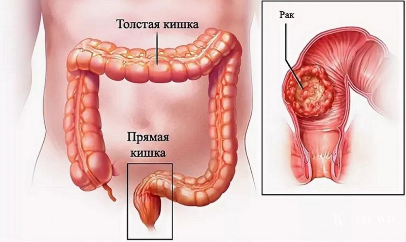 Железисто-плоскоклеточная карцинома прямой кишки