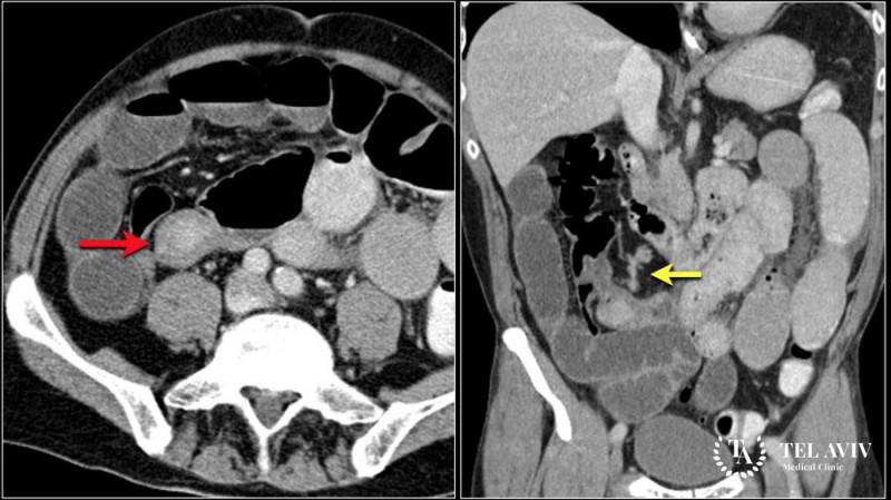 Карциноид пищевода