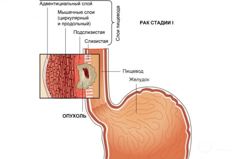 Первичная овсяноклеточная карцинома пищевода
