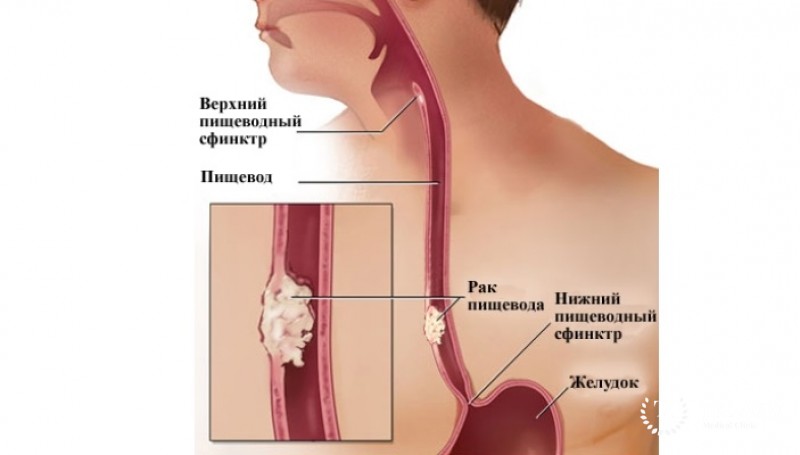 Немного о карциномах пищевода