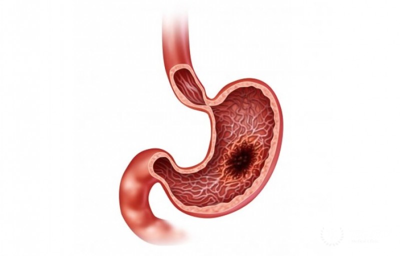 Плоскоклеточный рак желудка