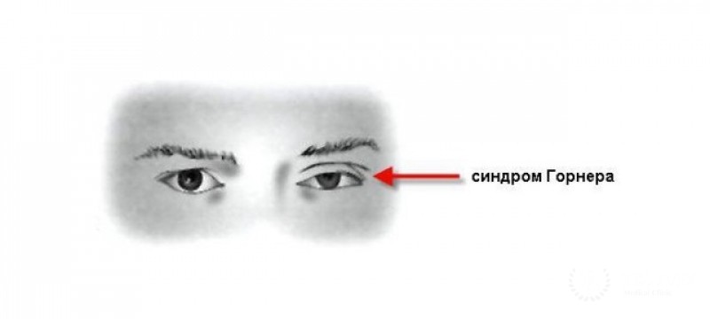 Синдром Горнера