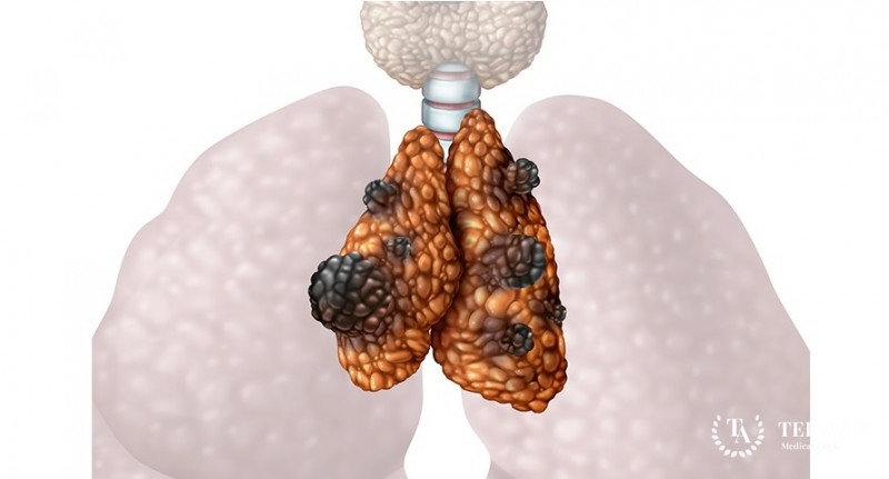 Карциномы тимуса