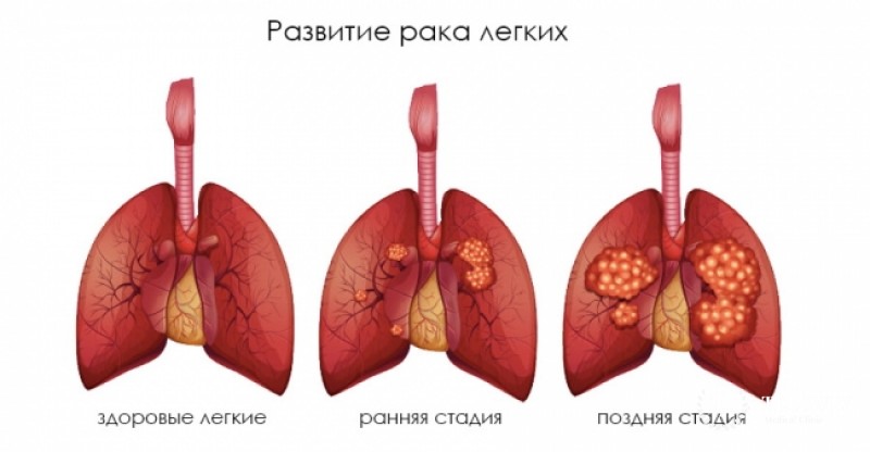 Легочная карцинома