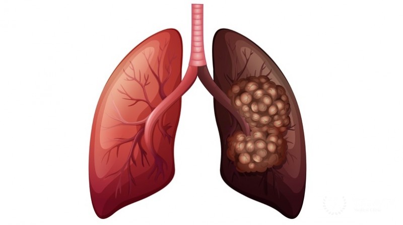 Мелкоклеточная карцинома легких (SCC)