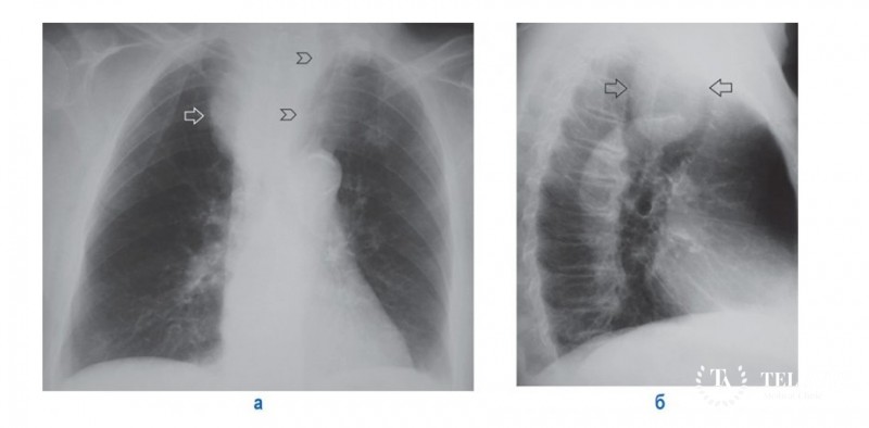 Внутригрудной зоб