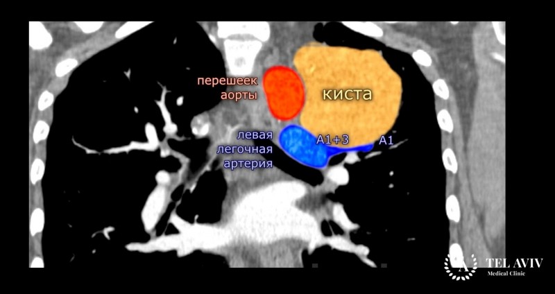 Бронхогенная киста