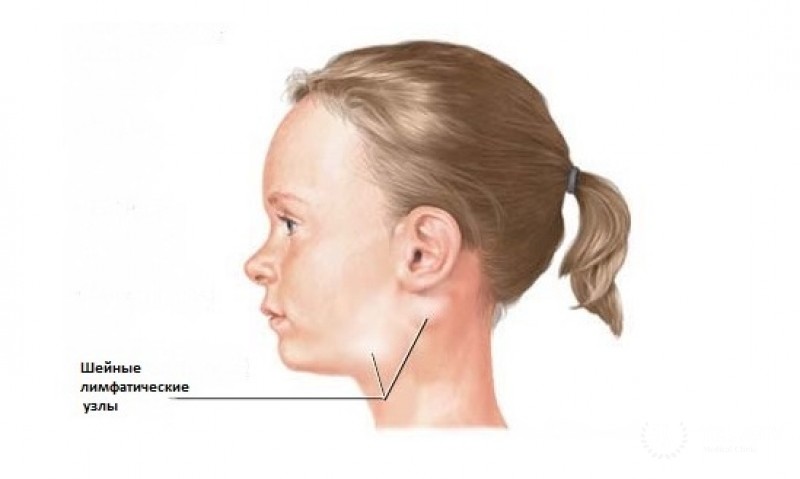 Индолентные неходжкинские лимфомы