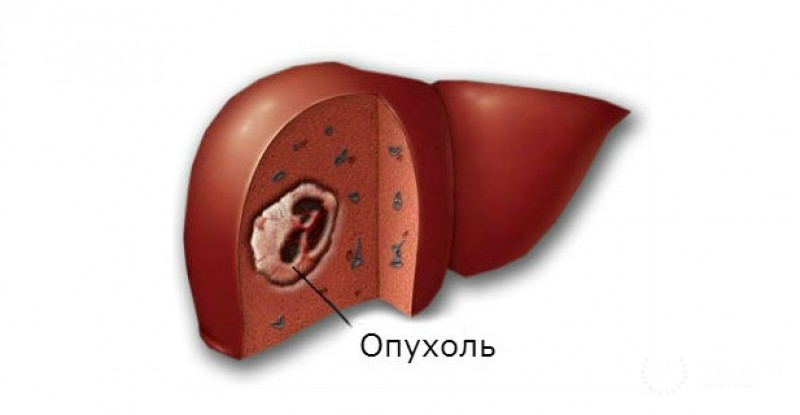 Фиброма печени