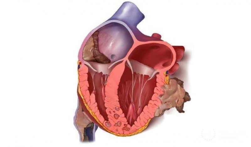 Миксома сердца