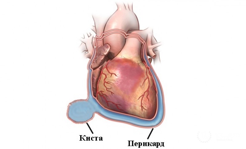 Перикардиальные кисты