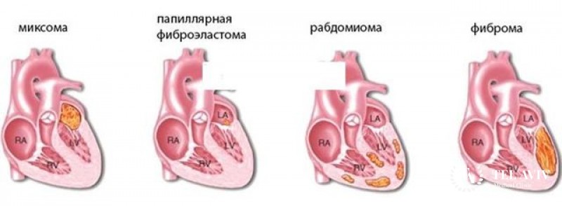 Папиллярная фиброэластома сердца