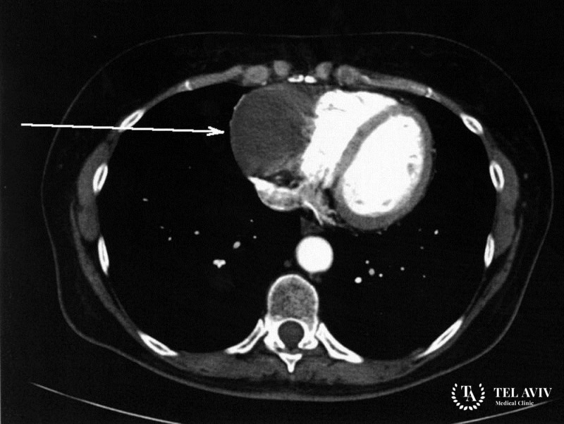 Параганглиома сердца