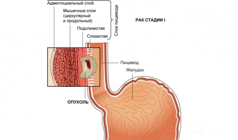 Мукоэпидермоидная карцинома пищевода