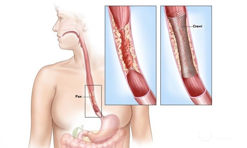 Аденокарцинома пищевода