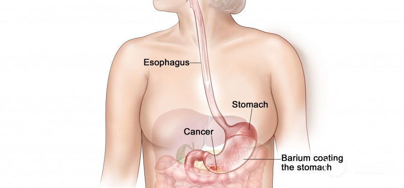 Diagnosis and treatment of cancer of the esophagus
