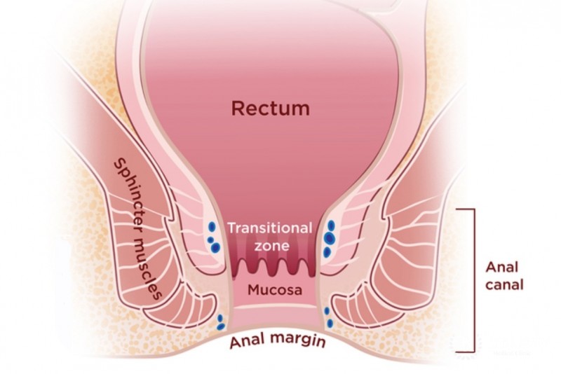 Squamous cell carcinoma of the anal canal