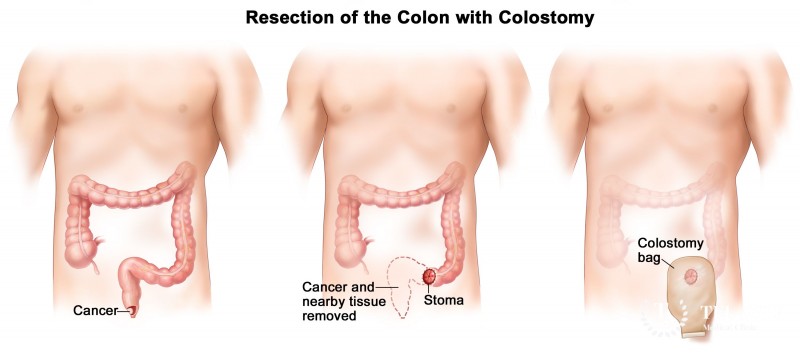 Cancer of the intestine: symptoms, diagnosis, treatment