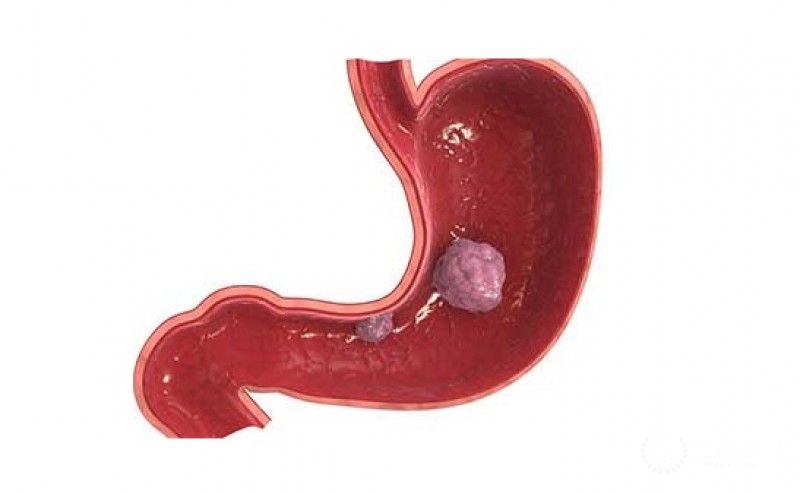Полиповидный рак желудка