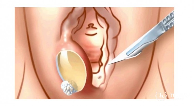 Киста наружных половых органов