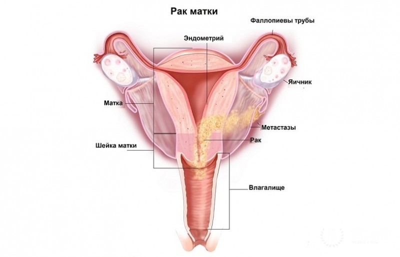 Онкология  эндометрия и тела матки