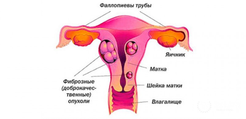 Фиброма матки
