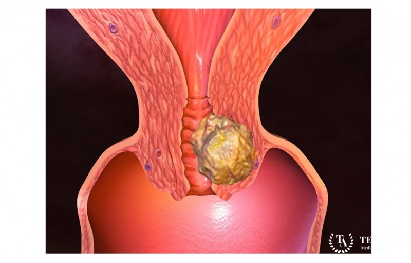 Саркомы матки