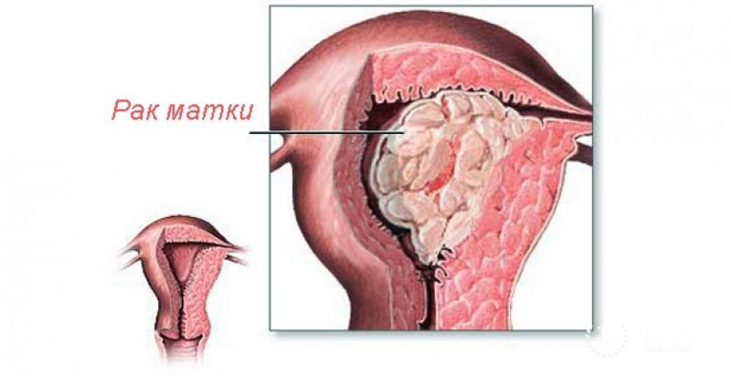 Карциномы матки