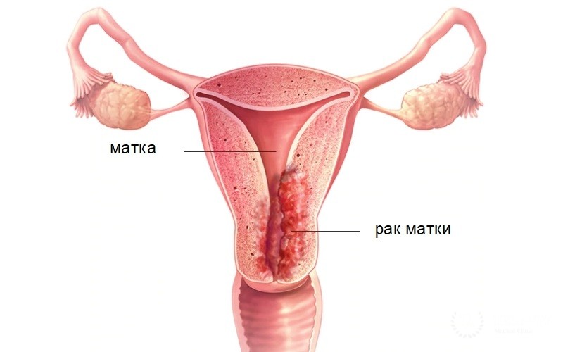 Эндометриоидная аденокарцинома(карцинома эндометрия)