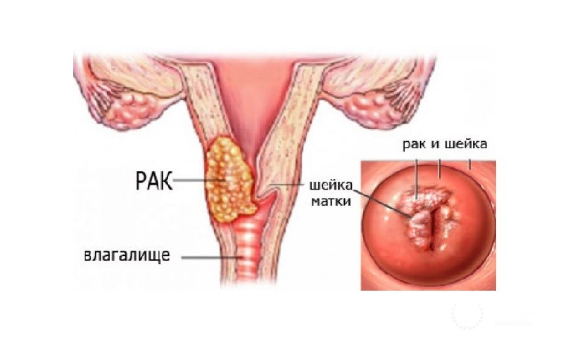 Аденосквамозная карцинома матки