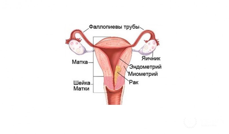 Аденокарцинома матки