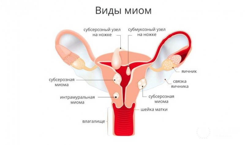 Миома матки