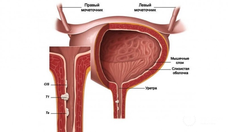 Онкология уретры