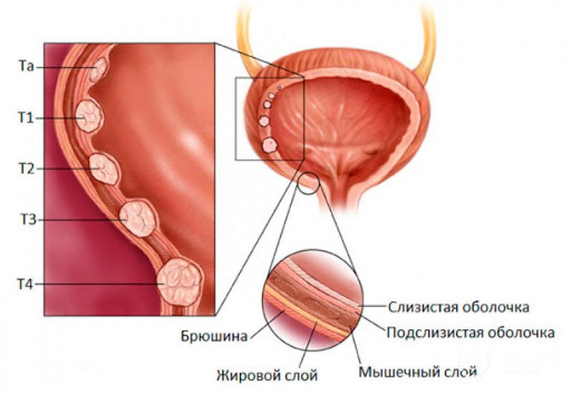 Переходно-клеточная карцинома (уротелиальная карцинома)