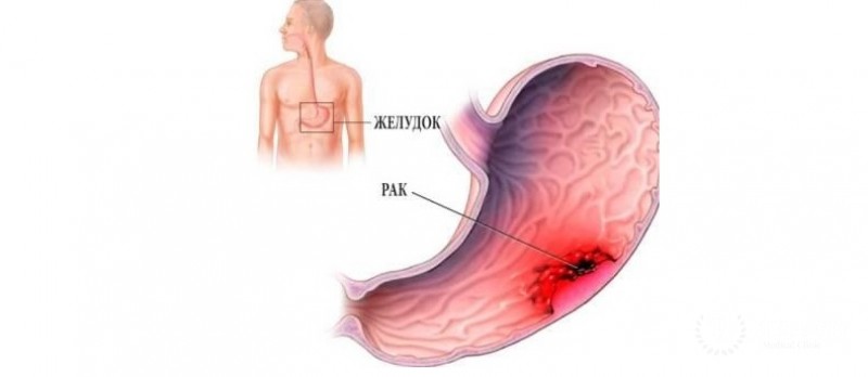 Диффузно-инфильтративный рак (скирр) желудка
