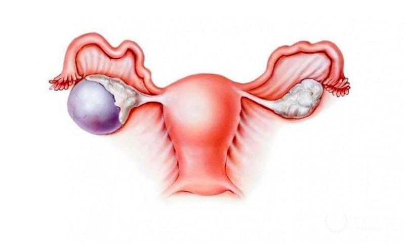 Арренобластома яичников