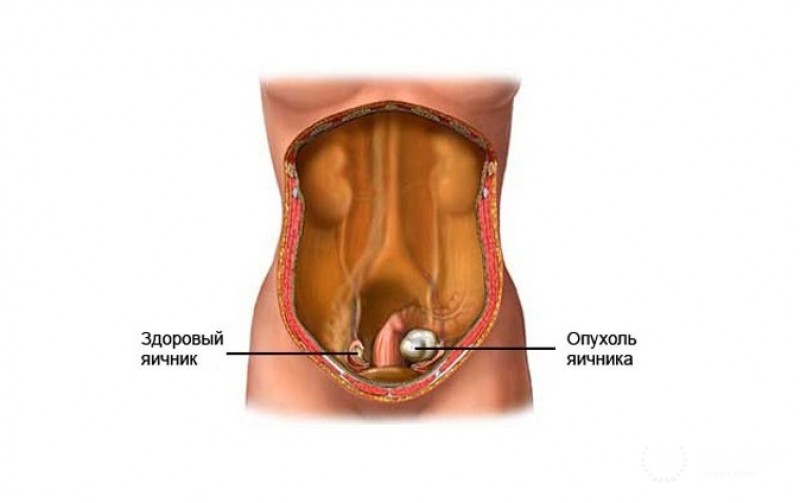 Андробластома яичника