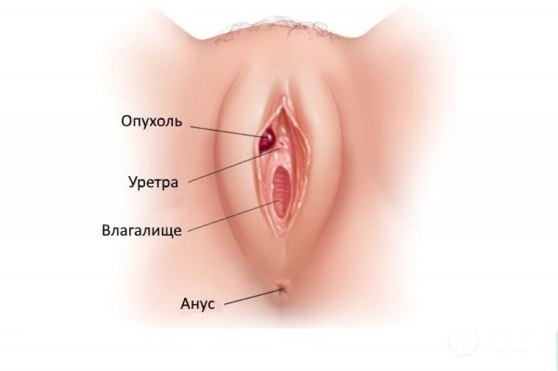 Онкология вульвы