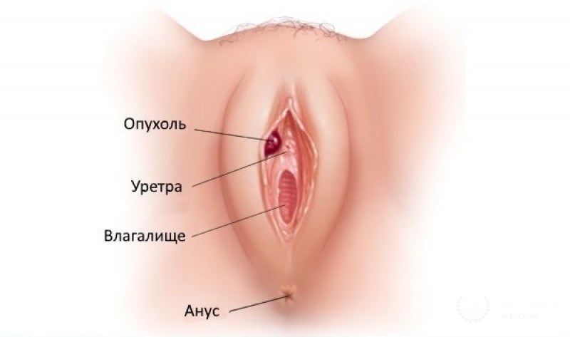 Аденокарцинома вульвы