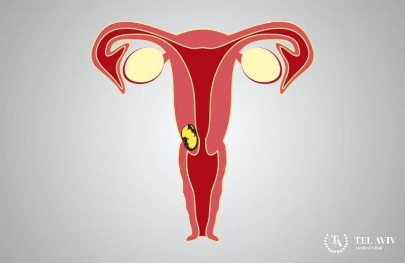 Онкология влагалища