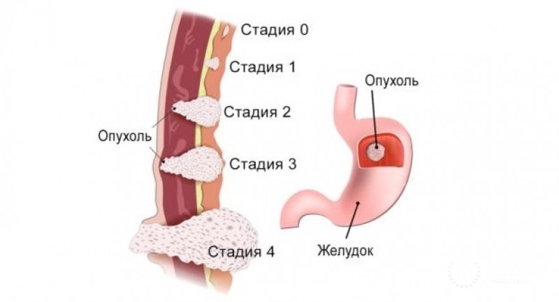 Железисто-плоскоклеточный рак желудка