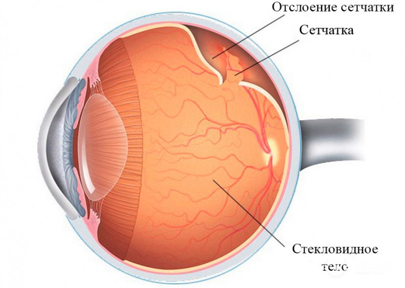 Глиома сетчатки