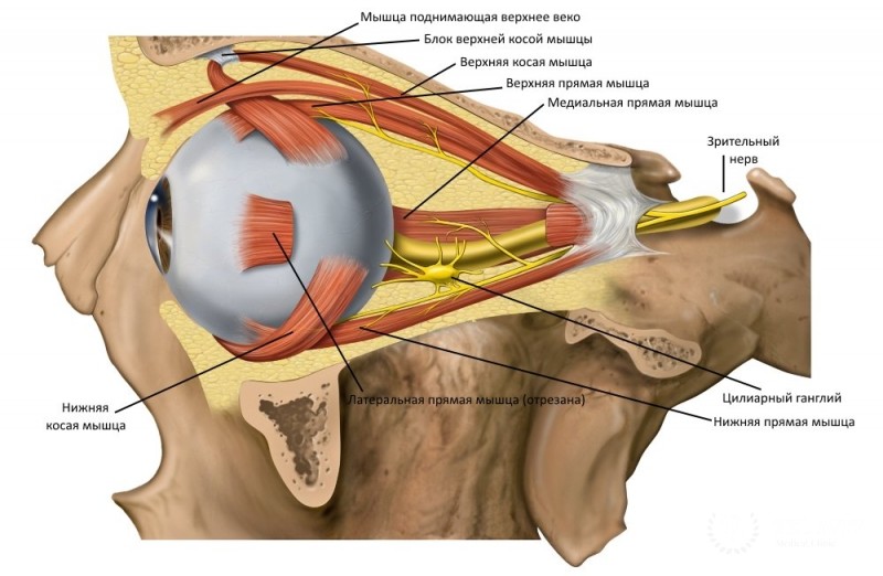 Нейрофиброма орбиты