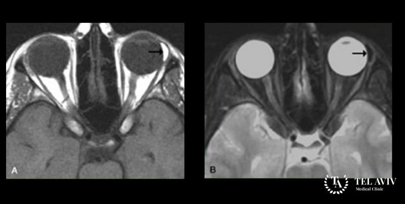 Котомковидная дермоидная киста орбиты