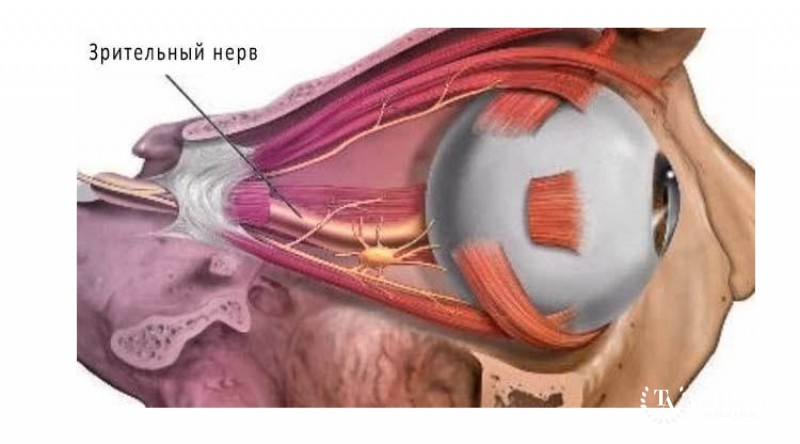 Глиомы зрительного нерва