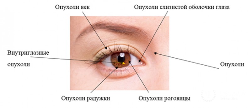 Внутриглазные сосудистые опухоли