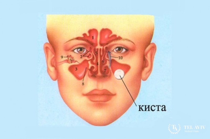 Слизистая киста придаточных пазух (Мucocele)