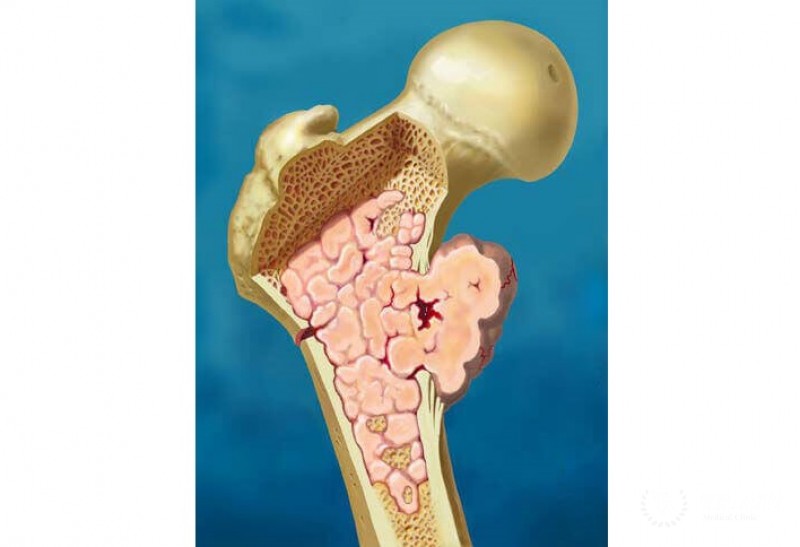 Вторичные метастазы в костях