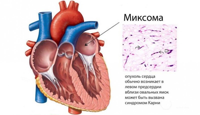 Миксомы